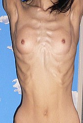 anorexia_victims06.jpg