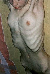 anorexia_victims14.jpg